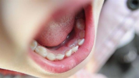 Et barn har mistet en tann Nærbilde av underkjeven til et barn