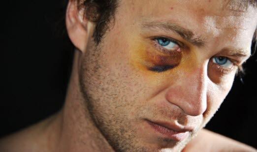 Black eye (periorbital hematoma) Nærbilde av en mann som har et mørkt blåøye