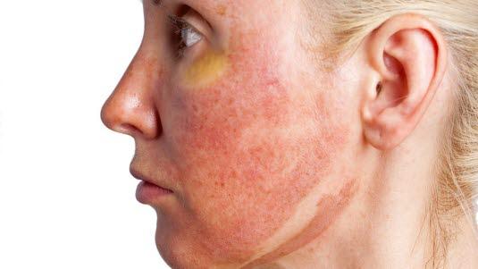 Superficial burn, face Sideprofil av et ansikt med brannskader