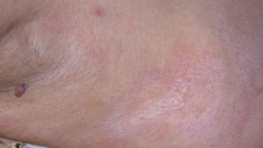 Lichen sclerosis ekstragenital