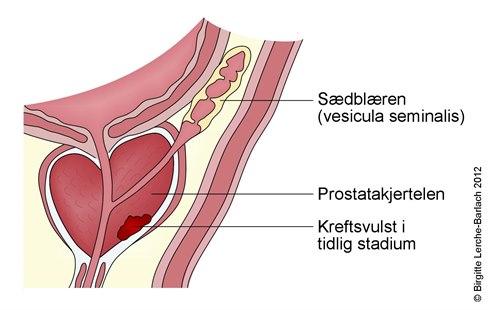 Prostatakreft stadium 1