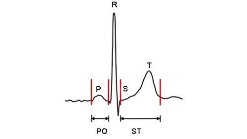 De ulike delene av EKG-komplekset