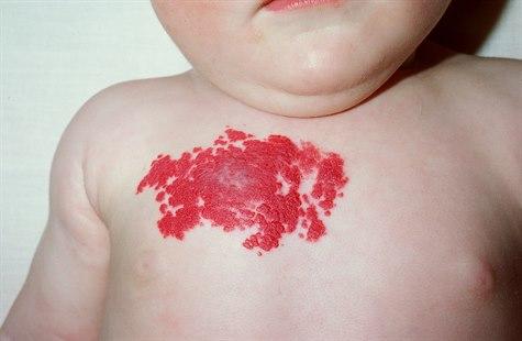 Hemangiom, proliferasjonsfasen 2