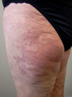 Utbredt granuloma annulare Utbredt granuloma annulare