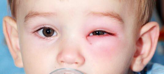 Hovent ye Nærbilde av et ansikt til et småbarn som har et rødt og hovent øye