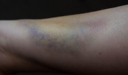 Blåflekk Illustrasjonsfoto av en blåflekk som har både gul, blå og lilla nyanser