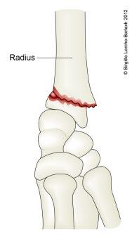 Håndleddsbrudd, radiusbrudd