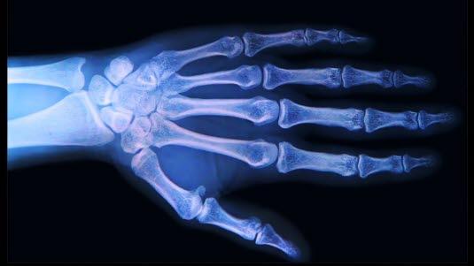 Røntgen av fingerledd