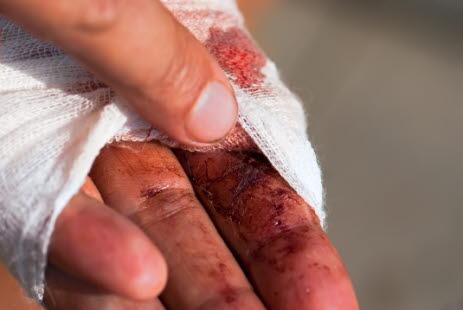 Fingerskade.jpg
