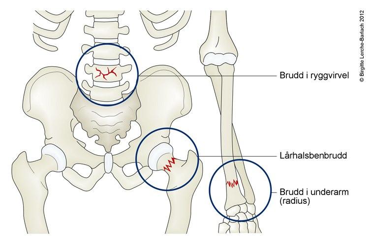 Bruddsteder ved beinskjørhet