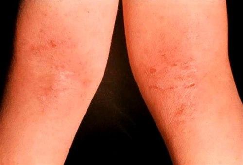 Atopisk eksem i knehaser