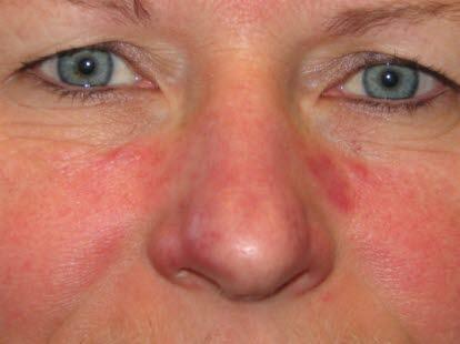 Rosacea, mild