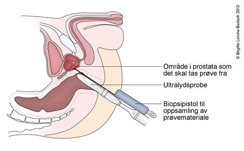 Transrectal prostata biopsy