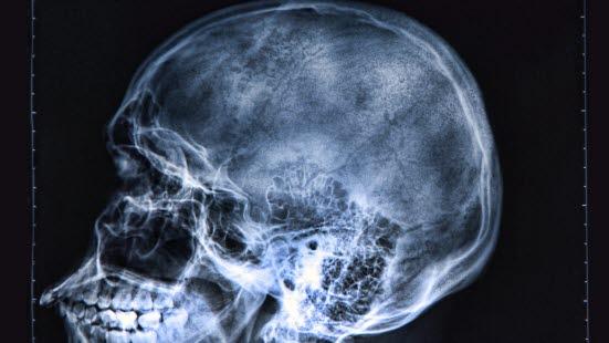 Hodeskalle Røntgenbilde av en hodeskalle