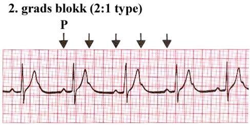 AV-blokk grad II (B)