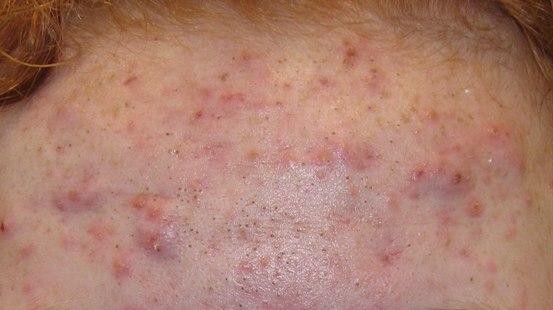 Acne, macro comedonal