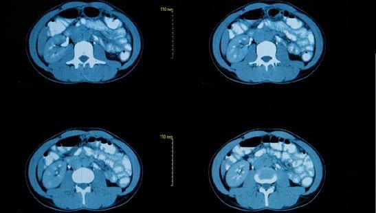 Computed tomography of the chest