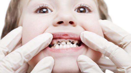 Tannrte Barn med tannråte