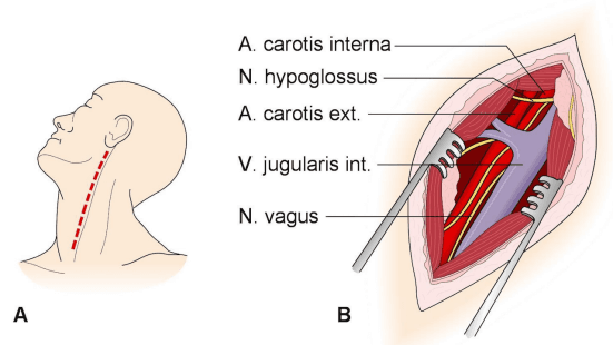 Carotid endarterectomy