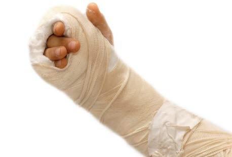 Gips Brukket arm med gips