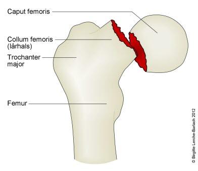 Lårhalsbrudd, større forskyvning Lårhalsbrudd, større forskyvning