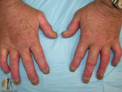 Psoriasisartritt (pølsefingre)