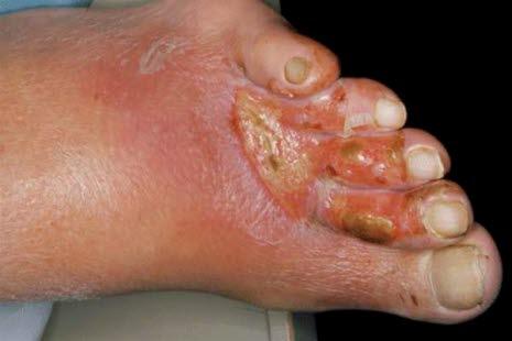 Wound, toe, peripheral artery disease (PAD)