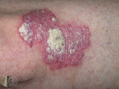 Psoriasis, plakk